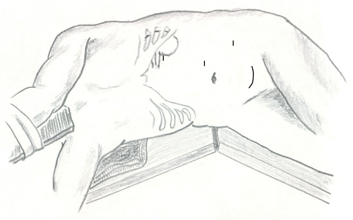 Skizze der Operation einer Nierenlebendspende